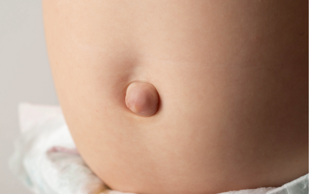 Ομφαλοκήλη