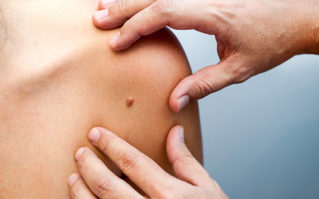 Καρκίνος Δέρματος